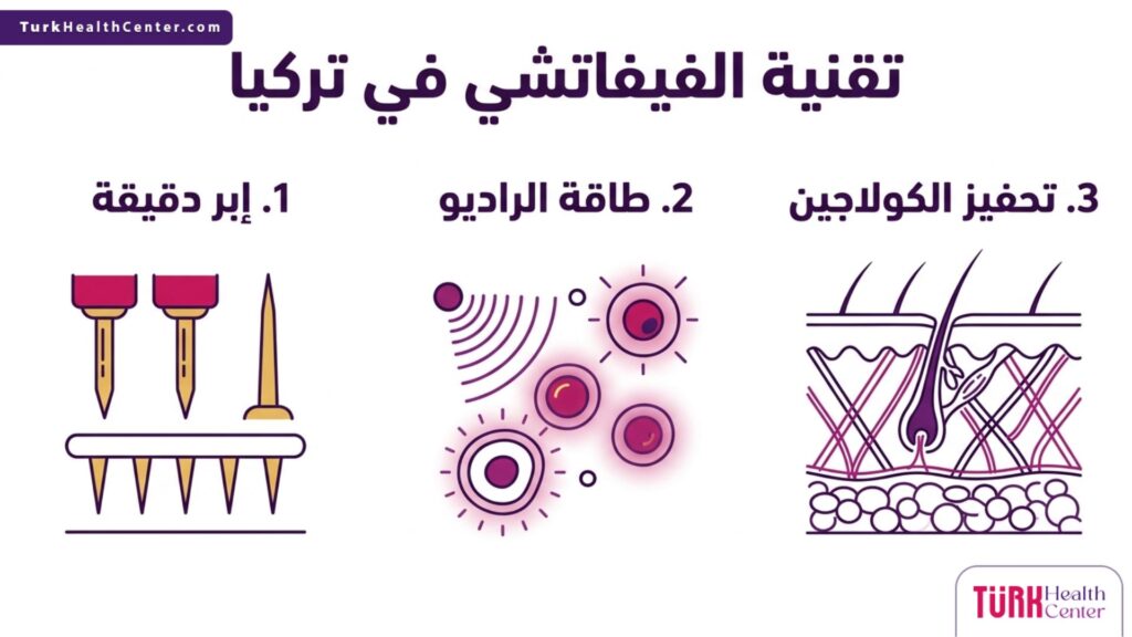 إنفوجرافيك تعليمي يستعرض خطوات ومزايا تقنية الفيفاتشي في تركيا لشد البشرة.