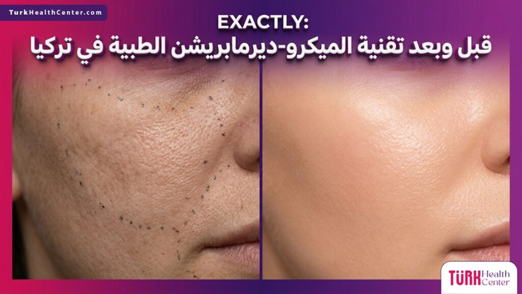 صورة مقسمة تظهر حالة البشرة قبل وبعد إجراء تقنية الميكرو-ديرمابريشن الطبية في تركيا مع توضيح الفروق الدقيقة في نضارة الجلد.