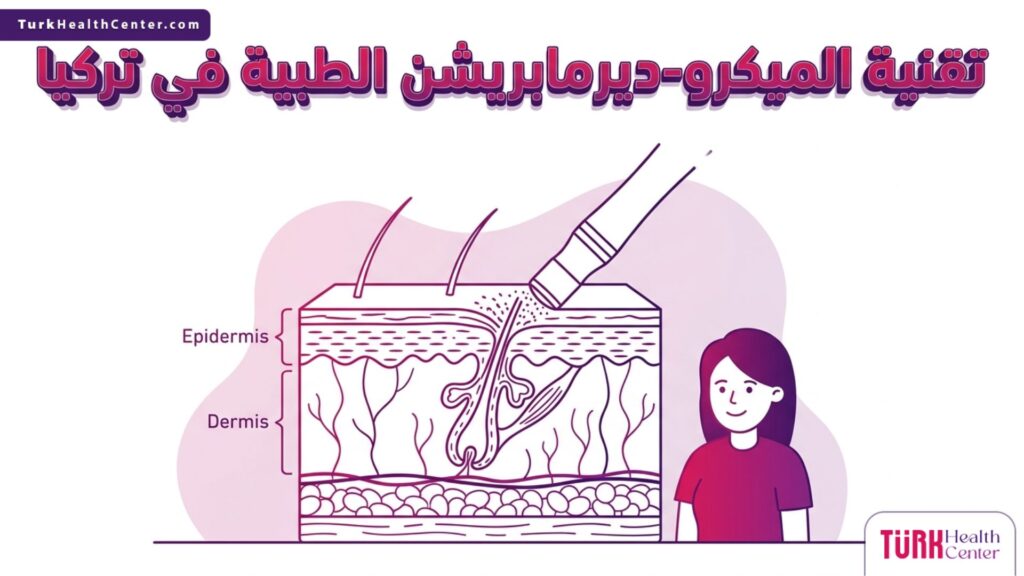 إنفوجرافيك طبي دقيق يشرح طبقات الجلد وكيفية عمل تقنية الميكرو-ديرمابريشن الطبية في تركيا.