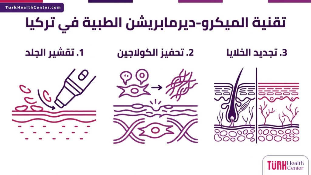 رسم بياني إنفوجرافيك يستعرض الخطوات والفوائد الرئيسية لـ تقنية الميكرو-ديرمابريشن الطبية في تركيا.