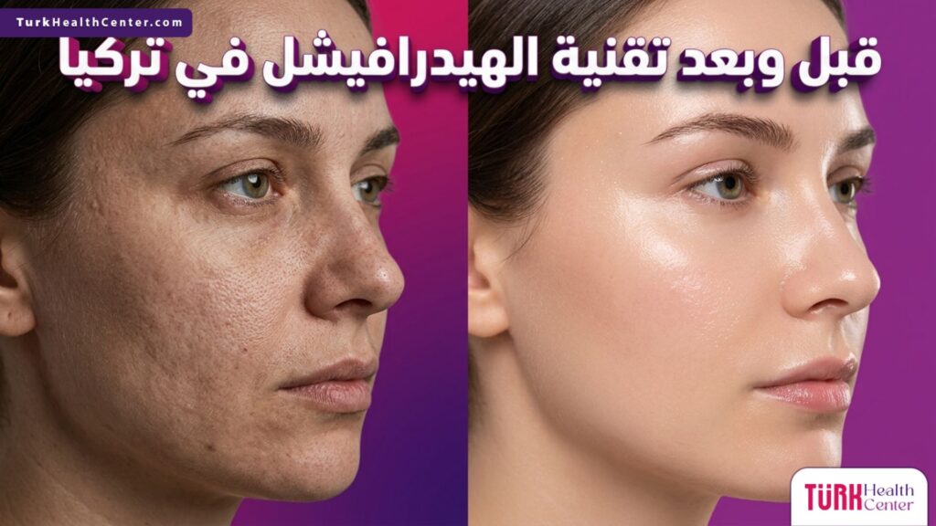 مقارنة بصرية دقيقة تظهر البشرة قبل وبعد إجراء تقنية الهيدرافيشل في تركيا، توضح الفرق في النضارة والترطيب العميق.