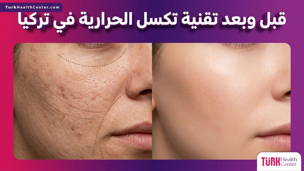 مقارنة قبل وبعد لتأثير تقنية تكسل الحرارية في تركيا على تجديد البشرة والتخلص من التجاعيد والندبات.