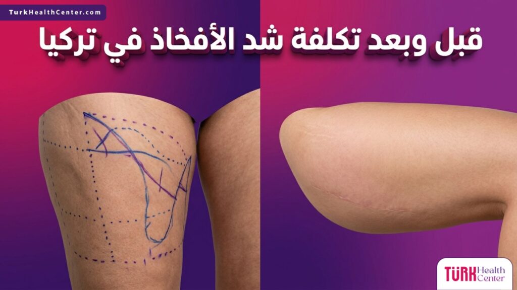صورة مقسومة تظهر الفخذ قبل العملية مع التخطيط الطبي، والنتيجة النهائية بعد العملية لتعكس قيمة تكلفة شد الأفخاذ في تركيا.
