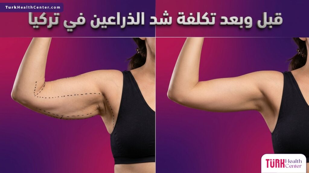 مقارنة بصرية قبل وبعد تظهر نتائج عملية شد الزنود وتوضيح تأثير تكلفة شد الذراعين في تركيا على المظهر النهائي.