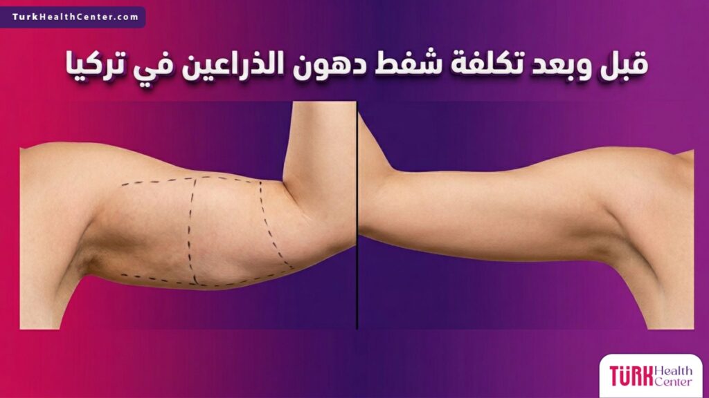مقارنة قبل وبعد نتائج الإجراء عند البحث عن تكلفة شفط دهون الذراعين في تركيا مع توضيح العلامات الجراحية
