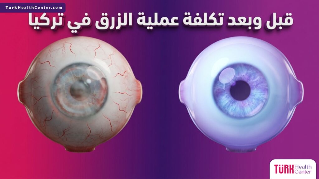 صورة مقسمة توضح الفرق في ضغط العين قبل وبعد العلاج ضمن مقال تكلفة عملية الزرق في تركيا.