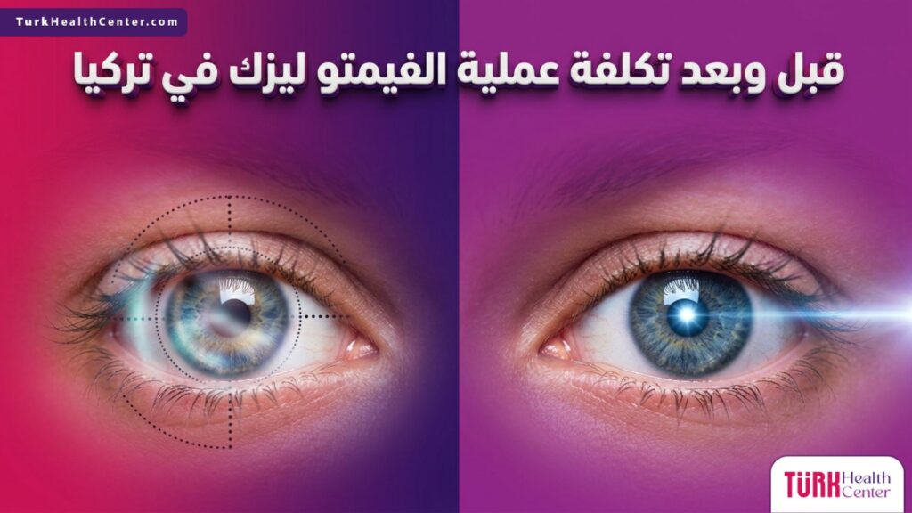 مقارنة بصرية قبل وبعد تصحيح النظر توضح جودة و تكلفة عملية الفيمتو ليزك في تركيا.