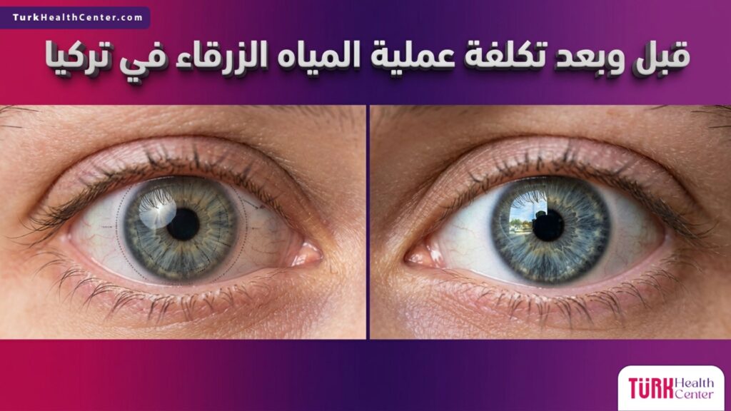 صورة مقسمة قبل وبعد توضح حالة العين ونتائج العلاج المرتبطة بموضوع تكلفة عملية المياه الزرقاء في تركيا بشكل واقعي ودقيق.