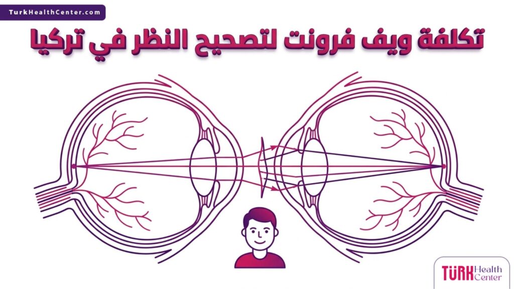 رسم تشريحي متجهي يوضح الآلية العلمية لقرنية العين ضمن تفاصيل تكلفة ويف فرونت لتصحيح النظر في تركيا.