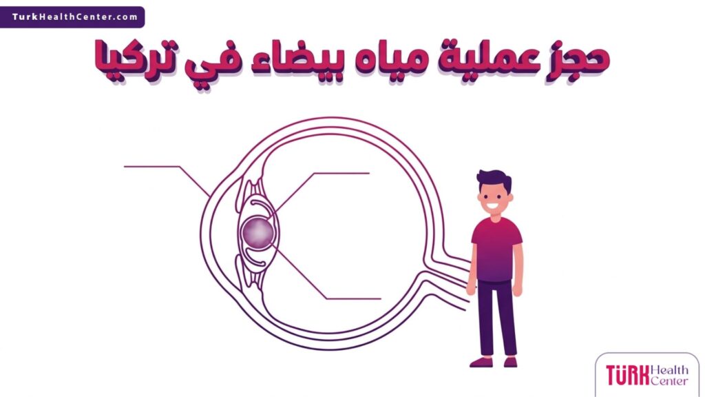 إنفوجرافيك تعليمي يوضح التشريح الطبي للعين وكيفية استبدال العدسة المعتمة عند حجز عملية مياه بيضاء في تركيا.