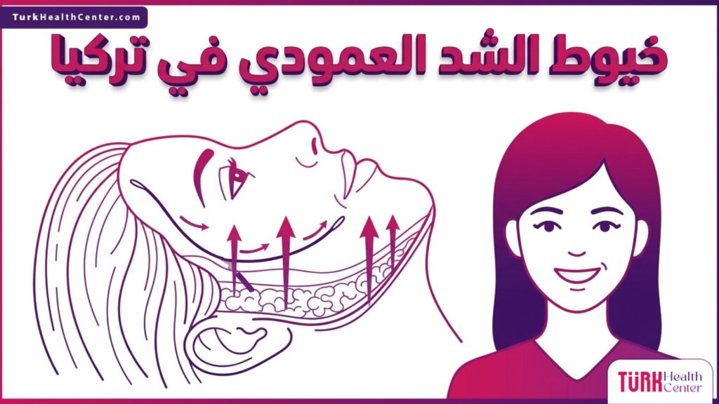 رسم تشريحي دقيق يوضح آلية عمل خيوط الشد العمودي في تركيا داخل طبقات الجلد