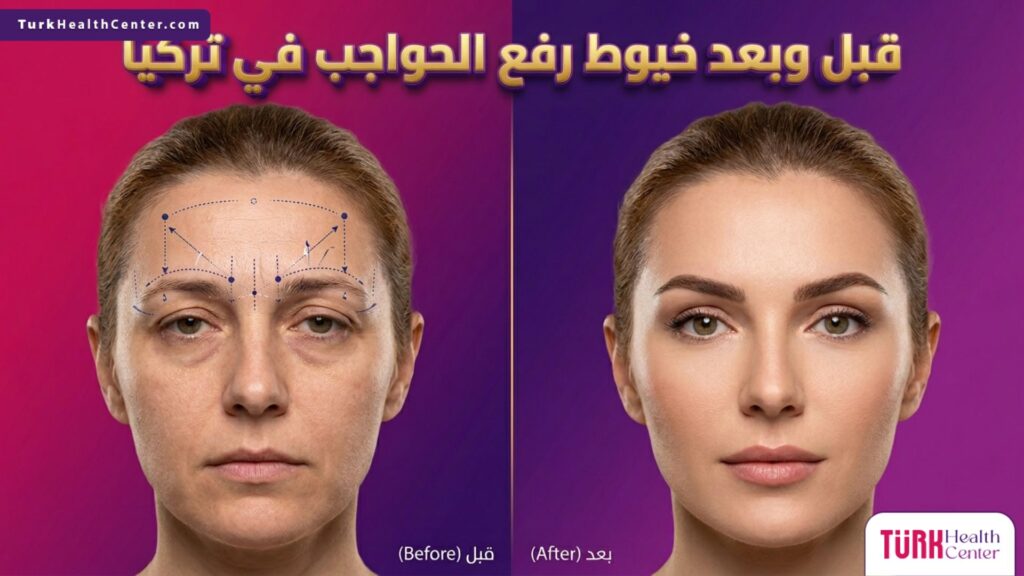 مقارنة قبل وبعد إجراء خيوط رفع الحواجب في تركيا توضح شد الجفون وإبراز جمال العين.