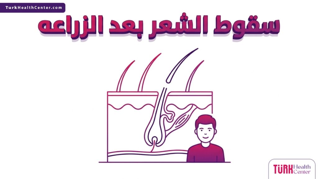 رسم توضيحي طبي ثلاثي الأبعاد يشرح آلية صدمة البصيلات و سقوط الشعر بعد الزراعه