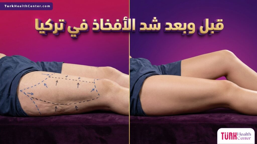 مقارنة قبل وبعد تظهر نتائج عملية شد الأفخاذ في تركيا وتنسيق القوام