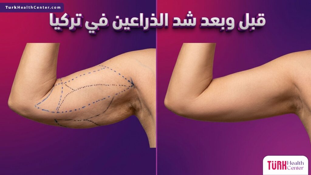 صورة واقعية مقسمة توضح شكل الذراع قبل وبعد إجراء عملية شد الذراعين في تركيا، مع إبراز التخلص من الترهلات.