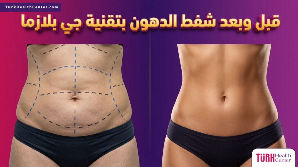 مقارنة قبل وبعد شفط الدهون بتقنية جي بلازما تظهر الفرق الواضح في شد الجلد ونحت القوام