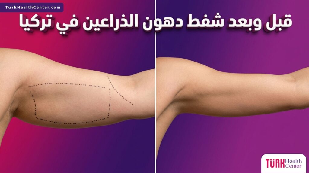 صورة مقارنة قبل وبعد تظهر نتائج عملية شفط دهون الذراعين في تركيا، تبرز التحول والتناسق العضلي الجمالي.