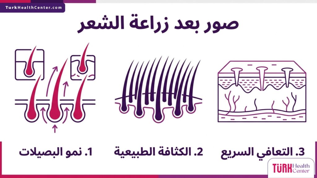 إنفوجرافيك طبي يشرح مراحل نمو وكثافة صور بعد زراعة الشعر.