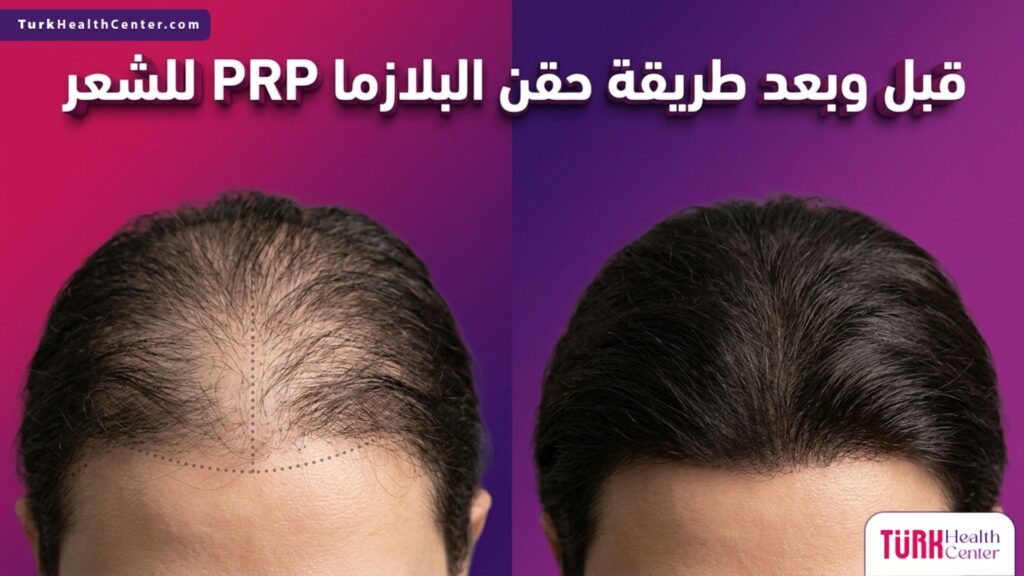 صورة مقسمة تظهر فروة الرأس قبل وبعد طريقة حقن البلازما PRP للشعر مع توضيح زيادة الكثافة ونمو البصيلات.