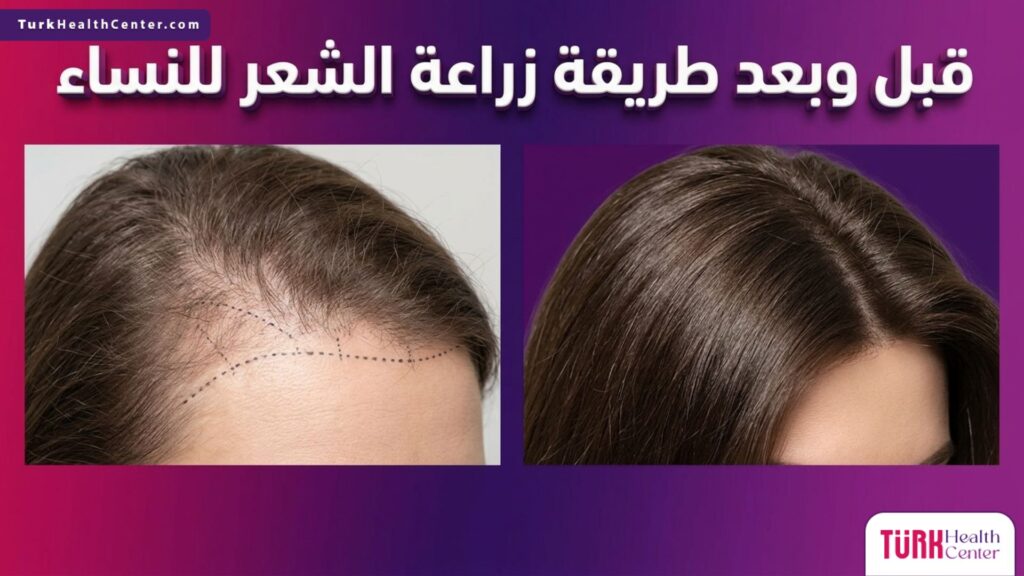 مقارنة قبل وبعد طريقة زراعة الشعر للنساء تظهر الفرق في كثافة الشعر واستعادة خط الشعر الأمامي.