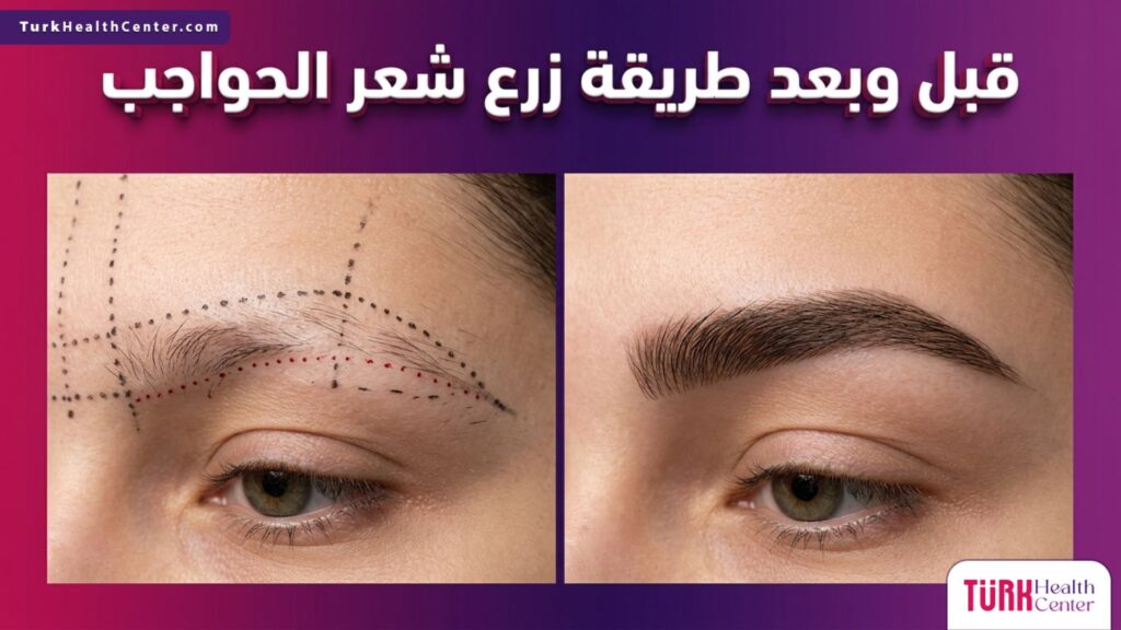 صورة مقسمة تظهر المريض قبل وبعد تطبيق طريقة زرع شعر الحواجب مع علامات التخطيط الجراحي.