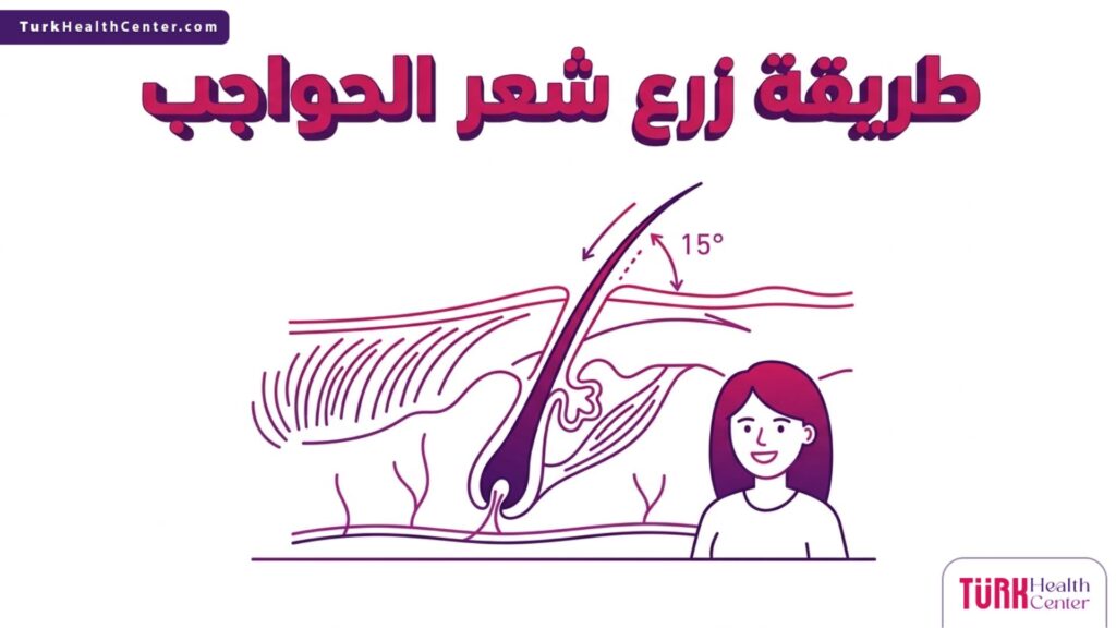 إنفوجرافيك تشريحي دقيق يوضح الزاوية الصحيحة لغرس البصيلات ضمن طريقة زرع شعر الحواجب.