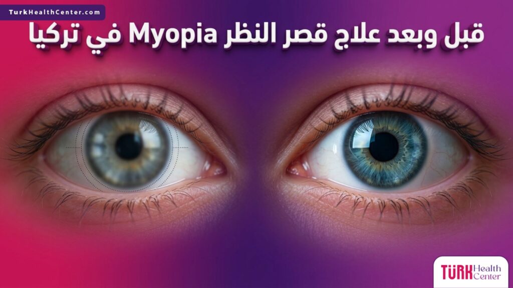 صورة مقارنة قبل وبعد توضح تحسن الرؤية من خلال علاج قصر النظر Myopia في تركيا.