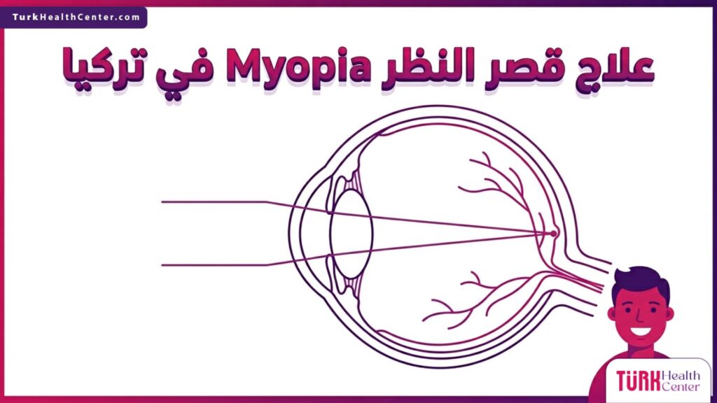 مخطط إنفوجرافيك تشريحي يوضح التركيب الداخلي للعين وآلية علاج قصر النظر Myopia في تركيا.