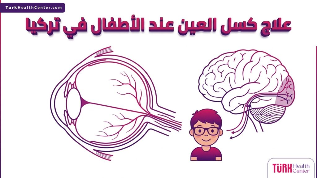 إنفوجرافيك طبي يوضح تشريح العين والعصب البصري المرتبط بخطوات علاج كسل العين عند الأطفال في تركيا.