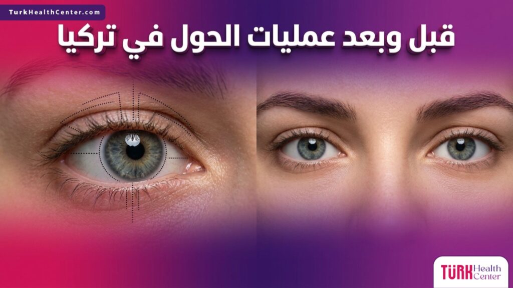 مقارنة قبل وبعد توضح تصحيح مسار العين واستقامة النظر بفضل عمليات الحول في تركيا.