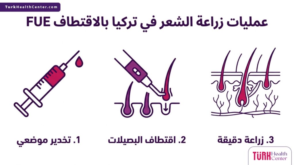 إنفوجرافيك طبي يوضح الخطوات الثلاث الأساسية في عمليات زراعة الشعر في تركيا بالاقتطاف FUE.