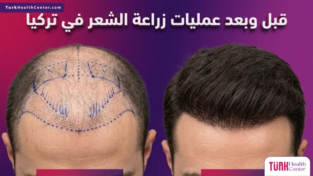 صورة مقسمة تظهر حالة فروة الرأس قبل وبعد عمليات زراعة الشعر في تركيا مع توضيح خطوط الزراعة الطبية والكثافة الناتجة.