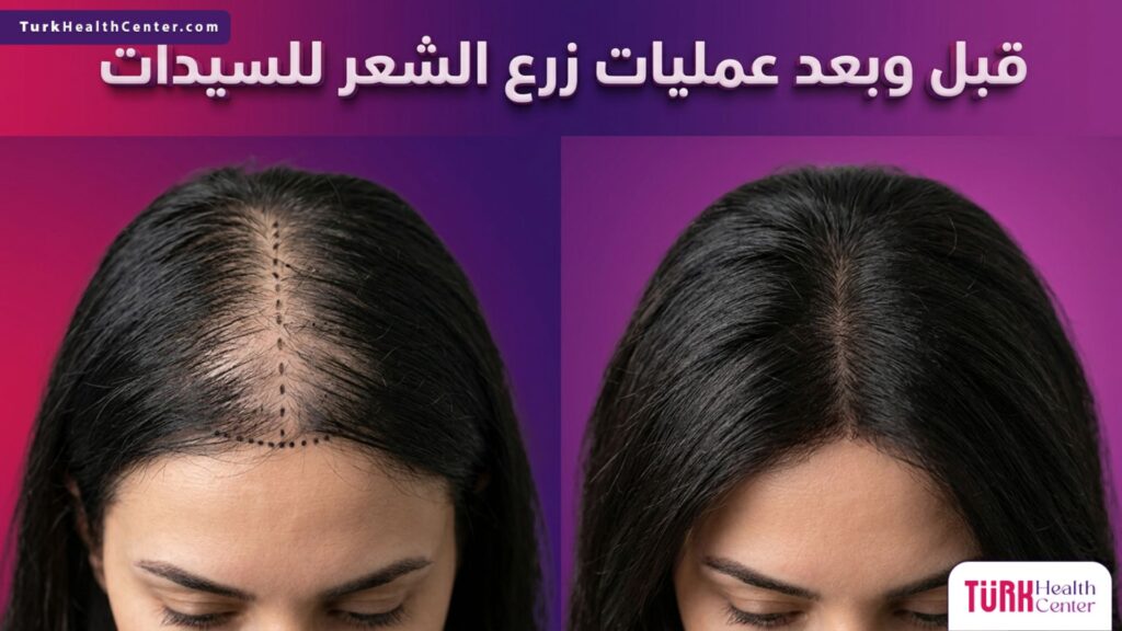صورة مقارنة تظهر فروة الرأس قبل وبعد عمليات زرع الشعر للسيدات مع توضيح كثافة الشعر الجديدة.