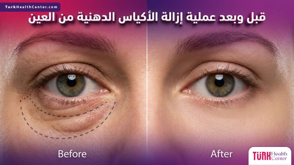 مقارنة قبل وبعد لنتائج عملية إزالة الأكياس الدهنية من العين مع علامات التخطيط الجراحي.