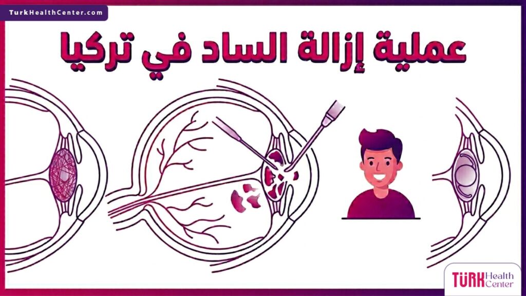 إنفوجرافيك تشريحي دقيق يوضح التركيب الداخلي للعين أثناء عملية إزالة الساد في تركيا.