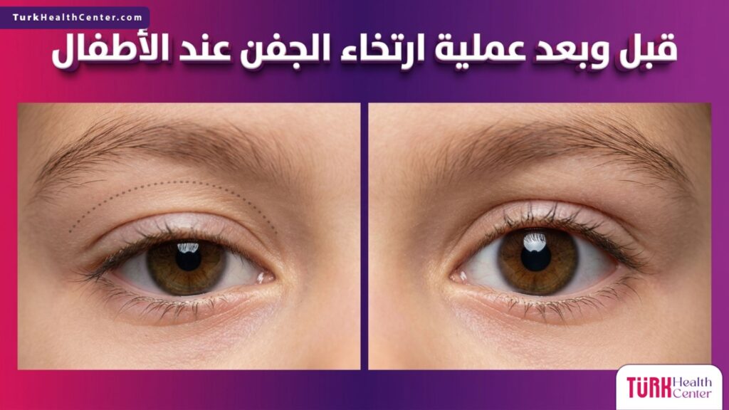 مقارنة بصرية قبل وبعد عملية ارتخاء الجفن عند الأطفال توضح رفع الجفن وتوسيع مجال الرؤية.