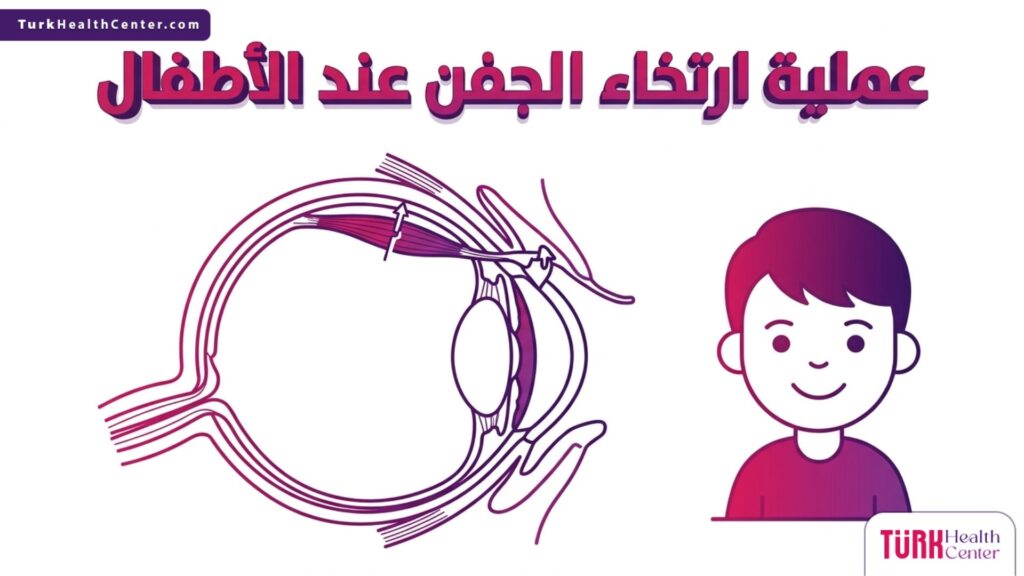 رسم تشريحي طبي يوضح العضلة الرافعة للعين وآلية عملية ارتخاء الجفن عند الأطفال.