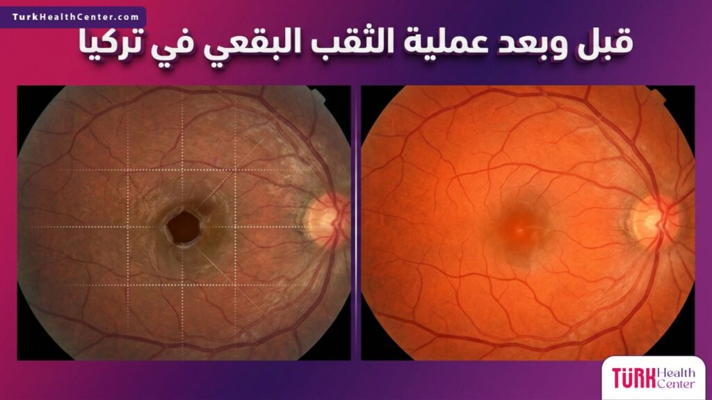 مقارنة قبل وبعد توضح نتائج عملية الثقب البقعي في تركيا على شبكية العين