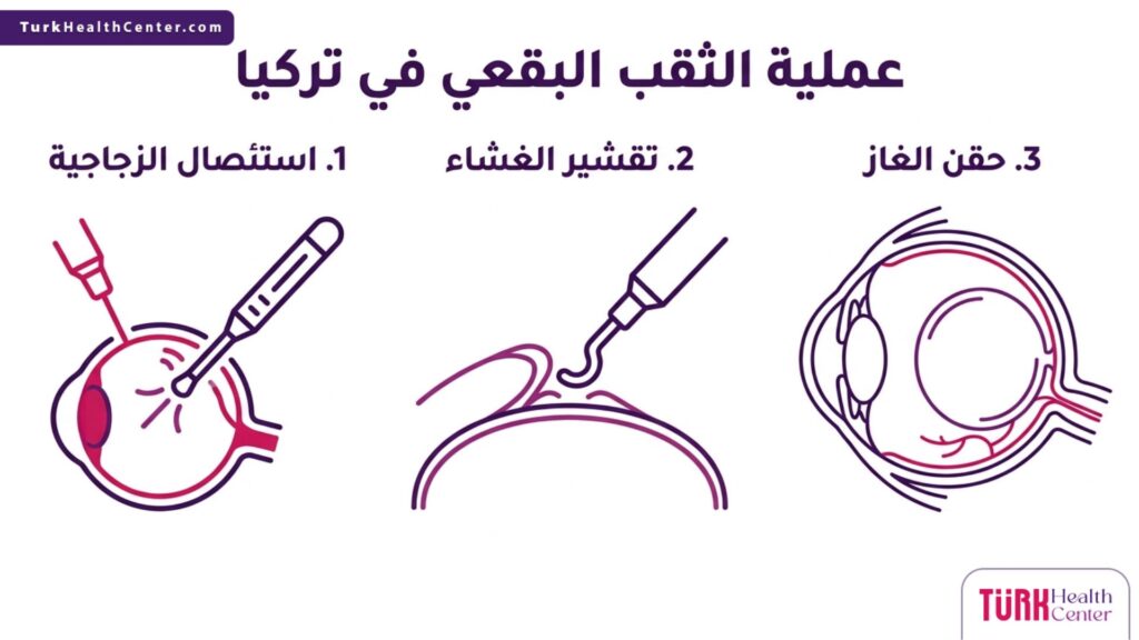 إنفوجرافيك علمي يلخص 3 مراحل أساسية لنجاح عملية الثقب البقعي في تركيا