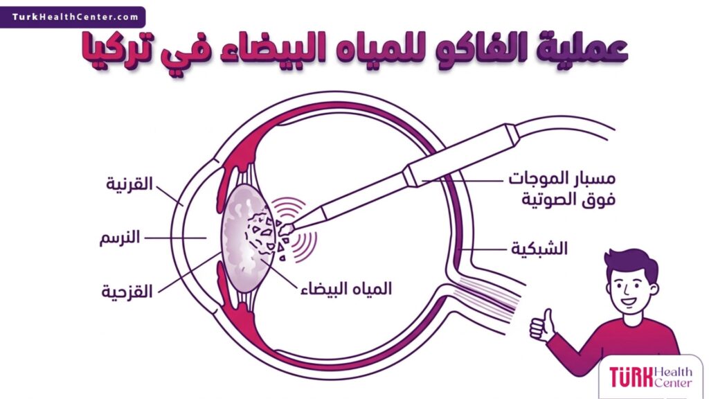 رسم تشريحي دقيق يوضح كيفية تفتيت العدسة بالموجات فوق الصوتية خلال عملية الفاكو للمياه البيضاء في تركيا.