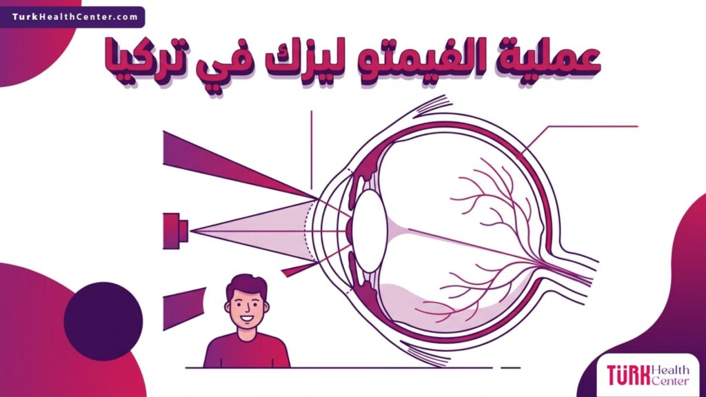 رسم تشريحي توضيحي يظهر طبقات القرنية وكيفية عمل شعاع الليزر الدقيق أثناء إجراء عملية الفيمتو ليزك في تركيا.