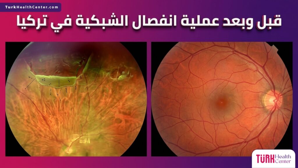 صورة مقارنة طبية ثلاثية الأبعاد قبل وبعد توضح نجاح عملية انفصال الشبكية في تركيا وتثبيت الشبكية.