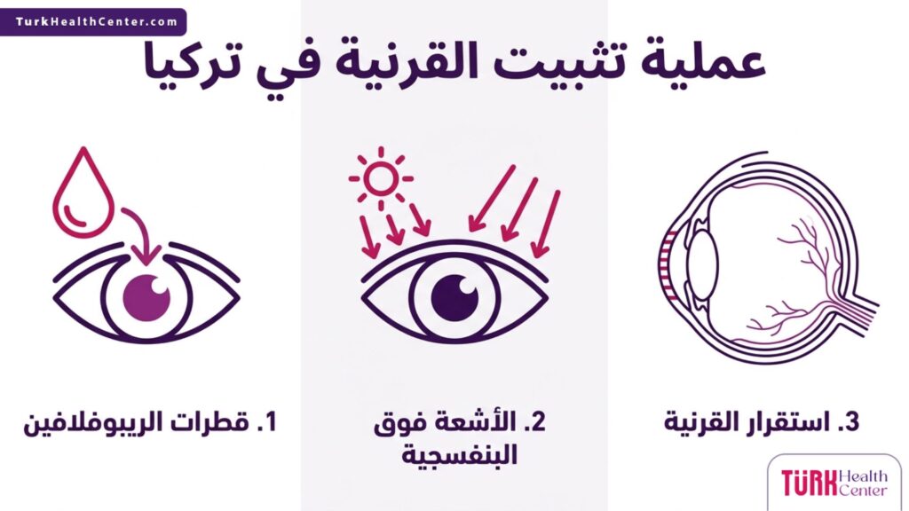 بوستر إنفوجرافيك طبي يشرح المراحل الثلاث الأساسية لتقنية تثبيت القرنية في تركيا باستخدام الريبوفلافين والأشعة.