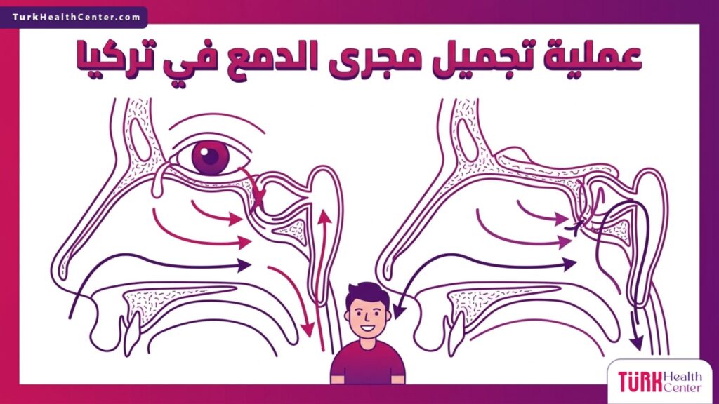 إنفوجرافيك علمي دقيق يوضح التشريح الداخلي لمسار الدموع والتحويلة الأنفية خلال عملية تجميل مجرى الدمع في تركيا.