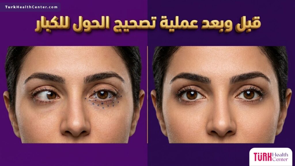 مقارنة قبل وبعد عملية تصحيح الحول للكبار تظهر استعادة الاستقامة الكاملة للعينين بشكل احترافي.