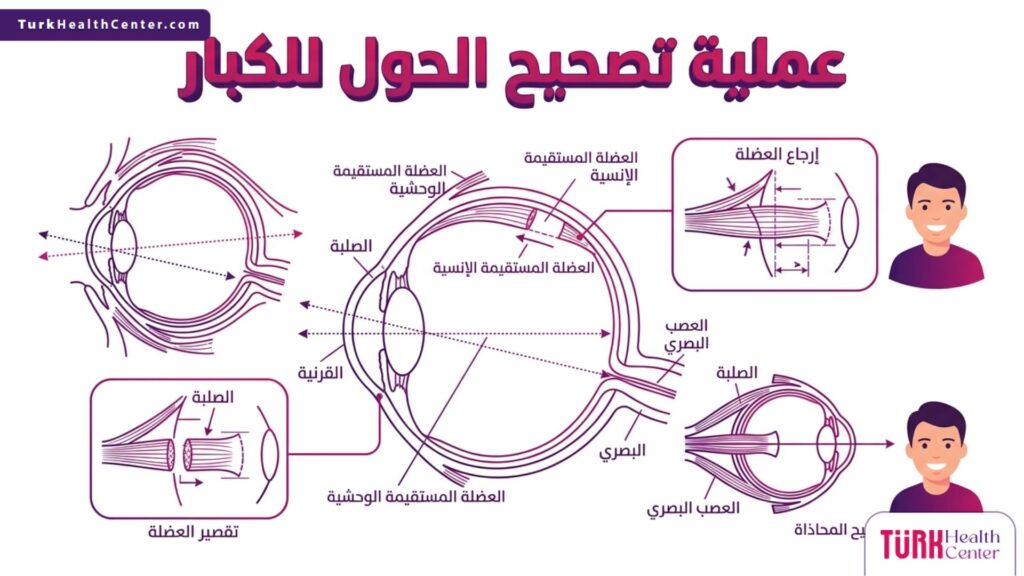 رسم تشريحي يوضح آلية عمل عملية تصحيح الحول للكبار من خلال تعديل عضلات العين للوصول للاستقامة.