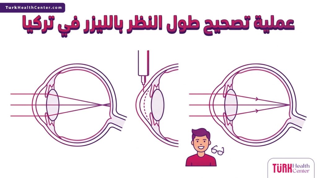 رسم تشريحي يوضح آلية عمل الليزر على القرنية خلال عملية تصحيح طول النظر بالليزر في تركيا.