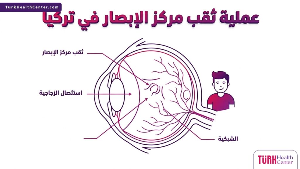 إنفوجرافيك طبي تشريحي يوضح التركيب الداخلي للعين والشبكية وكيفية إجراء عملية ثقب مركز الإبصار في تركيا.