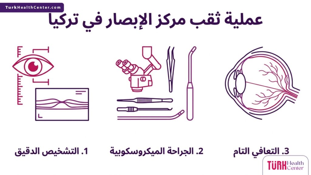 تصميم إنفوجرافيك يسلط الضوء على الخطوات الطبية الثلاث الرئيسية لنجاح عملية ثقب مركز الإبصار في تركيا.