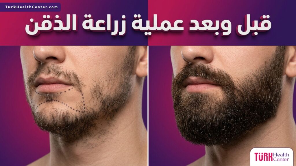 مقارنة قبل وبعد عملية زراعة الذقن تظهر الفرق بين الفراغات والكثافة الطبيعية الجذابة.